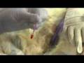 iM3 42-12 Ultrasonic Scaler