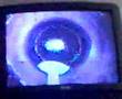 My Lasik eye operation