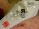 Staph Abscess Unpack/Repack