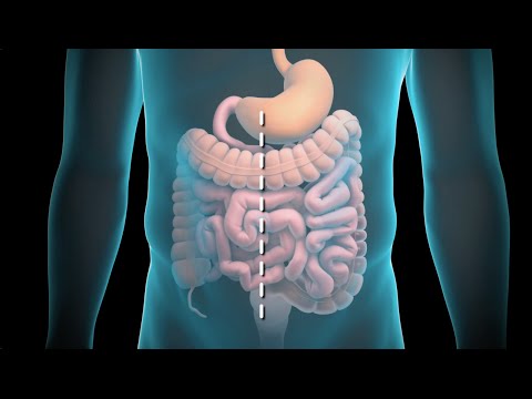 Colon Surgery - If you like this animation, LIKE us on Facebook: http://www.nucleusinc.com/facebook http://www.nucleusinc.com/medical-animation This 3D medical animation sho...