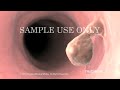 If you like this animation, LIKE us on Facebook: www.nucleusinc.com www.nucleusinc.com This 3D medical animation shows the normal digestive functions of the colon, outlines various conditions that may require surgery, and describes the colon resection procedure. Key steps include removing the affected segment of colon and stapling the two loose ends together.