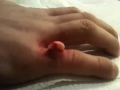 Ty's Cyst