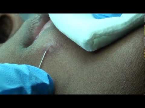 how to pop a pimple under the skin