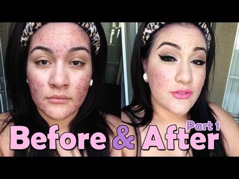 Foundation Routine for SEVERE Acne [PART ONE]