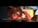 VSD Repair, Perimembranous Ventricular Septal Defect