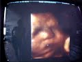 Ultrasonografia de Yasmini (9 meses de gestação)