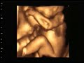 3d-ultrasonografia-bracos-pernas-bebe-ultra-som