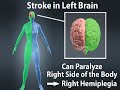 Effects of Stroke (Stroke Recovery #1)