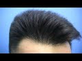Hair Transplant Results - 2970 Grafts 1 Session - Dr Hasson