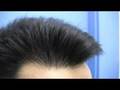 Dr Hasson Hair Transplant Surgery  - 2970 Grafts 1 Surgery Session - Dr Hasson