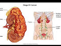 Melanoma Melanoma