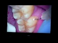 STA injection lower molar #31