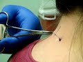 nape piercing
