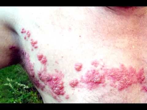 how to treat acne caused by vyvanse