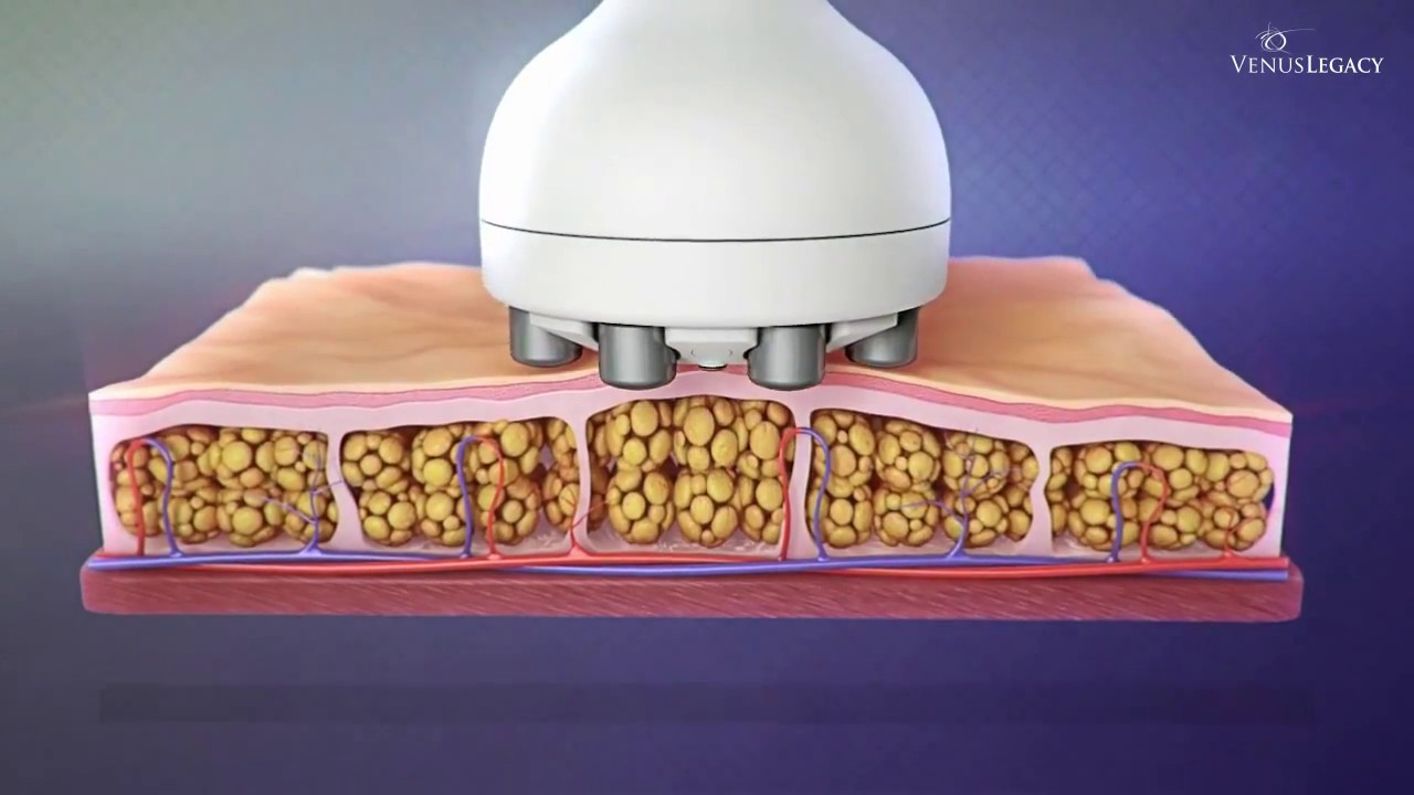 Venus Legacy en Equal | Tratamiento y Beneficios
