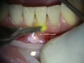 Periodontal Microsurgery: AlloDerm Grafting Lower Anterior