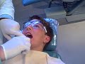 Braces off - removing Matthew's braces at Braces by Bergh in Glendale, CA by Dr. Brian H. Bergh, DDS, MS