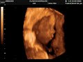 Ecografia fetal 3d 4d, fetal ultrasound, Clínica Morales Ecografia fetal 3d 4d, fetal ultrasound, Clínica Morales
