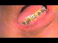Lower 2nd Bicuspid Ext Mech 2