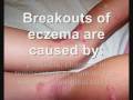 eczema