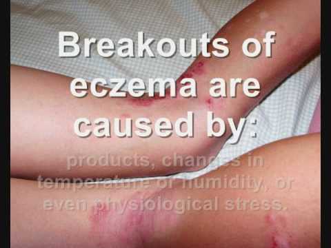 how to prevent eczema on face