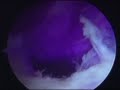 Baker cyst arthroscopic treatment ???????????? ???????????????