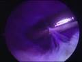 Endoscopic Cure For Baker Cyst Endoscopic Cure For Baker Cyst