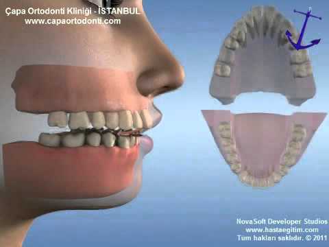 Çekimli ortodontik tedavinin yüzprofiline etkisi