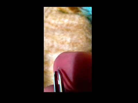 how to get a splinter out that is under the skin