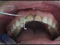A técnica de moldagem com silicona de adição e moldeira moldex é descrita.