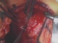 Movie 6 Subscapularis muscle incision