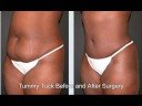 Orlando Tummy Tuck Surgery Before and After Orlando Tummy Tuck Surgery Before and After