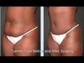 Orlando Tummy Tuck Surgery Before and After