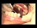 The Next Generation Implant and Mini Implant Part II