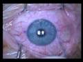 my lasik surgery my lasik surgery