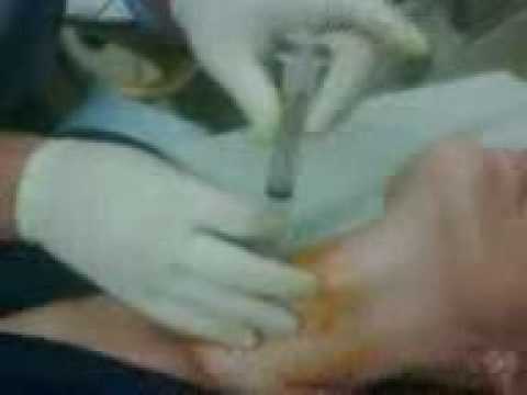 how to draw out a cyst