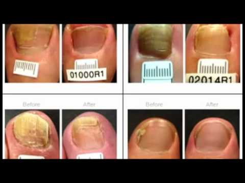 how to treat toenail fungus