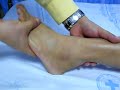 posteior ankle impingement preop examination ?????????? posteior ankle impingement preop examination ??????????