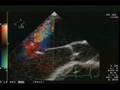 videos de TEE MR by LV tethering