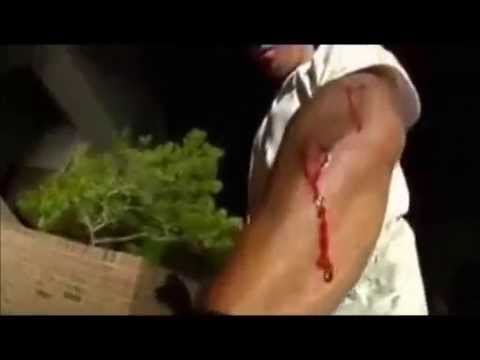 BMX Caidas, Accidentes y Fracturas