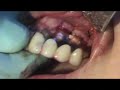 Crown Lengthening Part 7