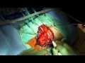 Resection of a cystic brainstem hemangioblastoma via a retrosigmoid approach