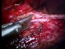 Lap Hellers for achalasia