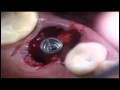 Extraction Et Implantation Immédiate Au Niveau D une Molaire Maxillaire.wmv