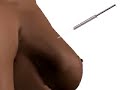 PreOp® Patient Education: Breast Biopsy Wire Guide Surgery 2