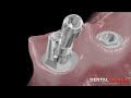 3D Dental Animation: Implants, abutments, copings, crowns and ceramic sequence