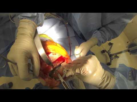 how to transplant knee