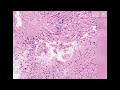 Histopathology Brain--Glioblastoma multiforme