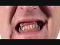 Rotten Teeth