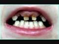 Rotten Teeth